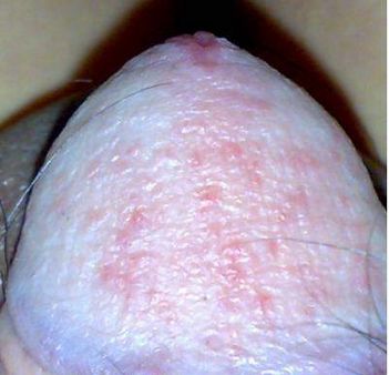 触动龟头炎的的原因是什么呢?