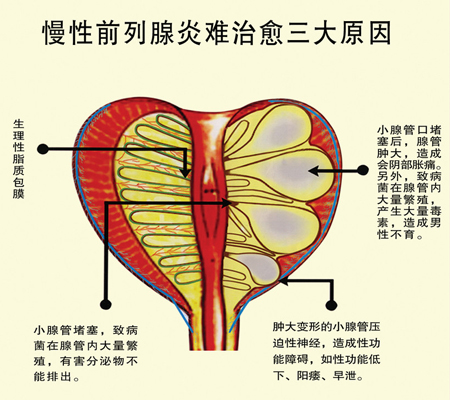 慢性细菌性前列腺炎有哪些特点?