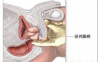 前列腺结石的原因