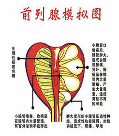 前列腺炎在生活中的危害有哪些