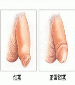 对男性包茎有什么预防方法吗?