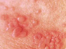 男性生殖器疱疹有哪些危害?