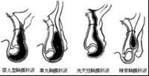 睾丸鞘膜积液的症状有哪些?